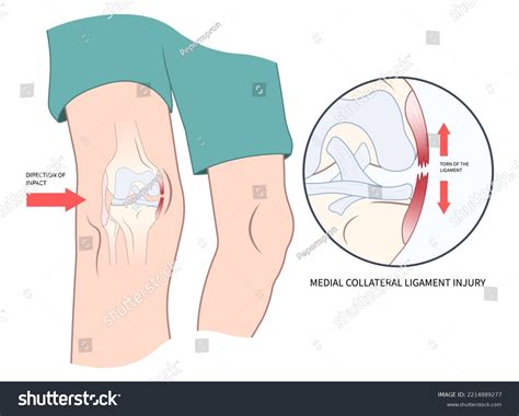 57 Sprain Rice Images, Stock Photos & Vectors | Shutterstock