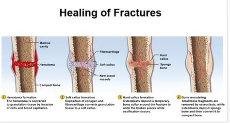 Bone healing and complications Flashcards | Quizlet