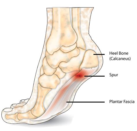 Heel Spur