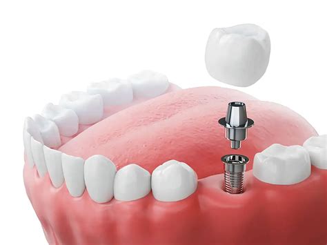 Image result for IV Line Wisdom Teeth