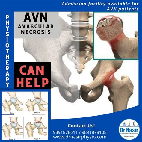 Avascular Necrosis (AVN) - Dr NasirPhysiotherapy and Rehabilation