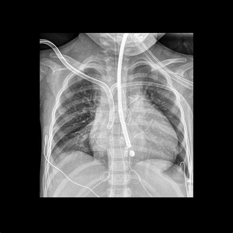Endotracheal Tube And Nasogastric Tube at Loretta Cyr blog