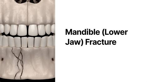 Mandible-Lower-Jaw-Fracture (1).pdf