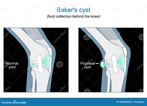 Baker's Cyst Anatomy at Sam Jimenez blog