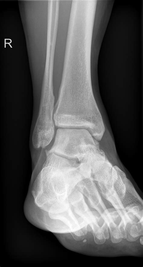 Avulsion Fracture Medial Malleolus at Nancy Hinman blog