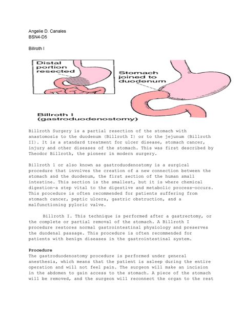 Billroth II - REVIEWERS - Angelie D. Canales BSN4-D Billroth I Billroth ...