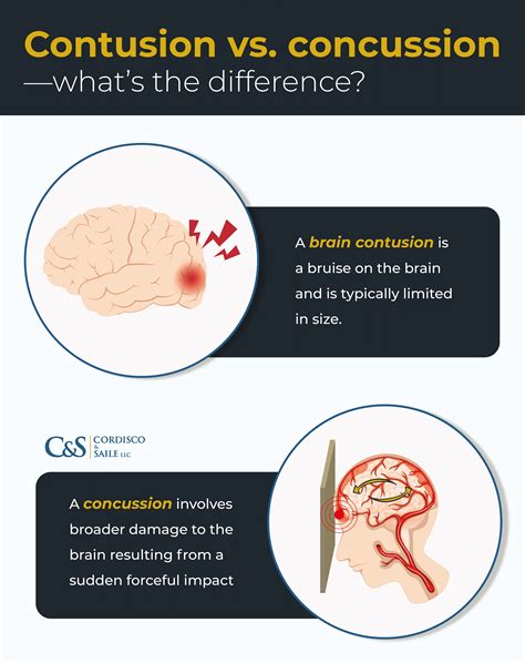 Contusion vs. Concussion | Cordisco & Saile LLC