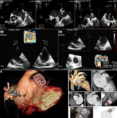 Left atrial appendage occlusion - EuroIntervention