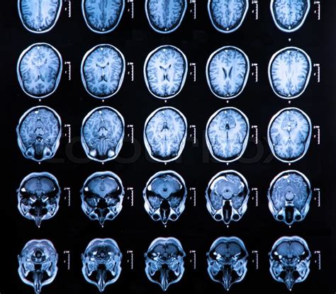 MRI scan of the human brain | Stock image | Colourbox