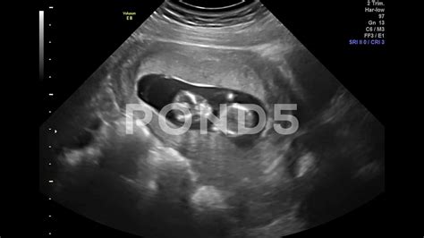 Baby Ultrasound At 12 Weeks