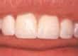 Making My Smile Better -Tooth Whitening & Tooth Bonding