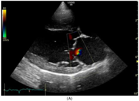 Prevalence of Echocardiographic Evidence of Trace Mitral and Aortic ...