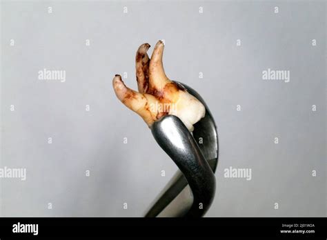 Extracted Wisdom Tooth 的图像结果