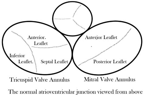 Atrioventricular Septal Defect: What Is in a Name?