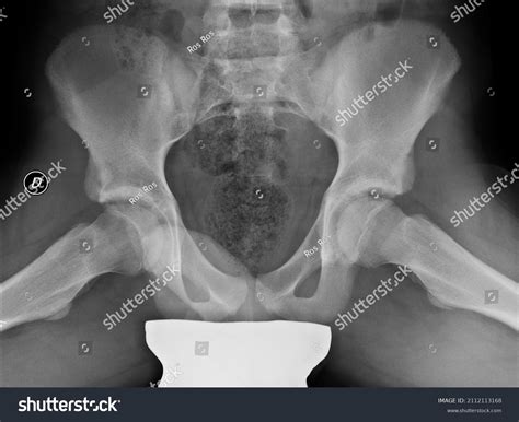 Frog Leg Lateral Hip Position at Mary Birch blog