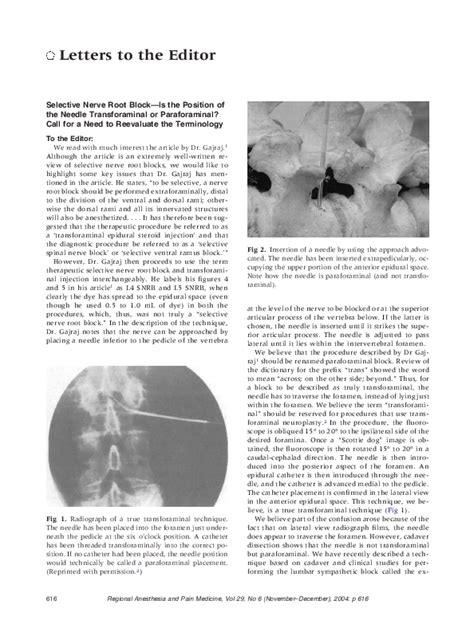 Image result for Selective Nerve Root Block vs Transforaminal