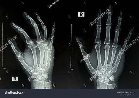 Xray Right Hand X Ray Of Broken Bone In Right Hand (M330/0042)" Art