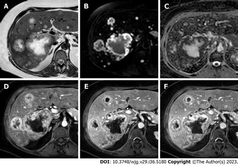 Liver metastases: The role of magnetic resonance imaging