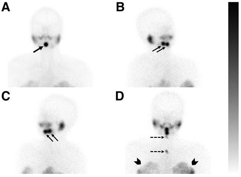 Nuclear Medicine Scan Thyroid Thyroid Uptake Of Technegas During V/Q