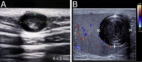 Epidermoid Cyst Scrotum Ultrasound – DAEB