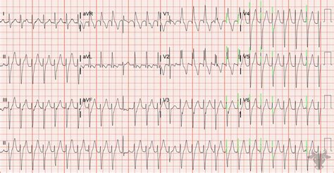 Paroxysmal Atrial Tachycardia Ecg