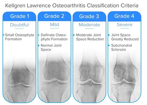 Guide to Severe Knee Arthritis (Osteoarthritis) - Spring Loaded Technology