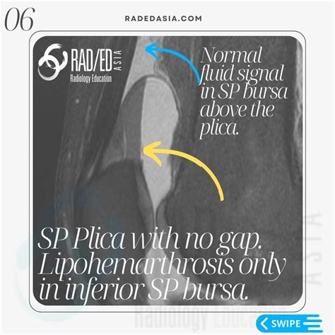 KNEE MRI PLICA SUPRAPATELLAR BURSA LIPOHEMARTHROSIS - Radiology ...