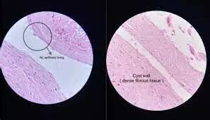 Rare case of asymptomatic huge primary retroperitoneal pseudocyst reported