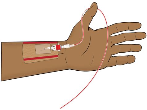 Image result for Arterial Line Procedure Note Template