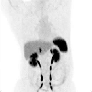 Image result for Maximum Intensity Projection Python