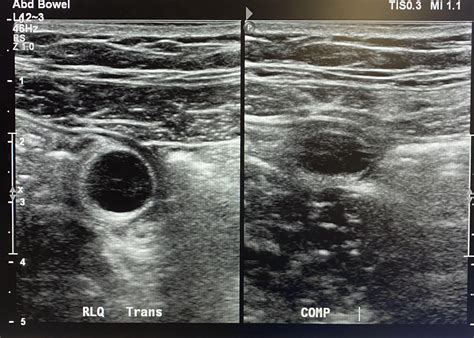 Appendicitis seen on transvaginal ultrasound : r/Radiology