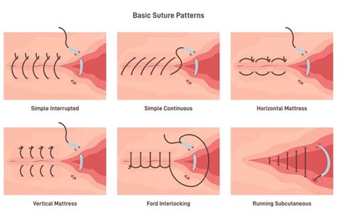 Image result for Simple Continuous Suture Removal