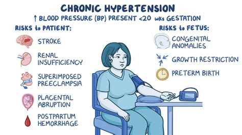 Chronic hypertension in pregnancy: Video & Meaning | Osmosis