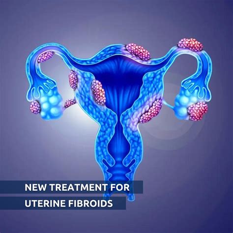 Drug trial shows promise for easing uterine fibroids. | Dianox