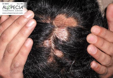 Scarring Alopecia Regrowth