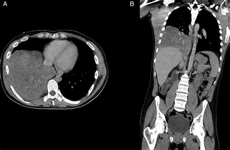 Congenital pulmonary airway malformation (CPAM) with initial ...
