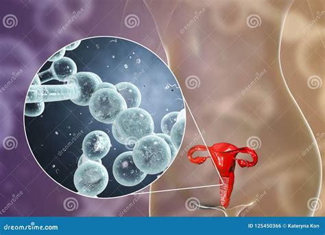 Vaginal Thrush, Female Candidiasis Stock Illustration - Illustration of ...