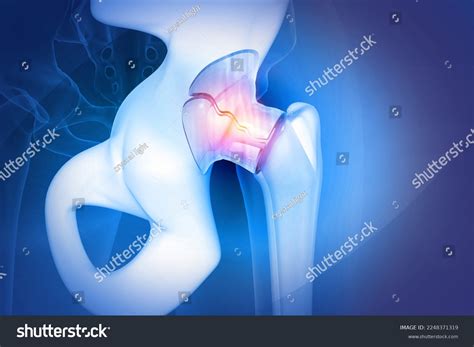413 Cracked Bone X Ray Images, Stock Photos & Vectors | Shutterstock