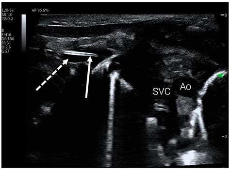 Standardized Ultrasound Protocol for Peripherally Inserted Central ...