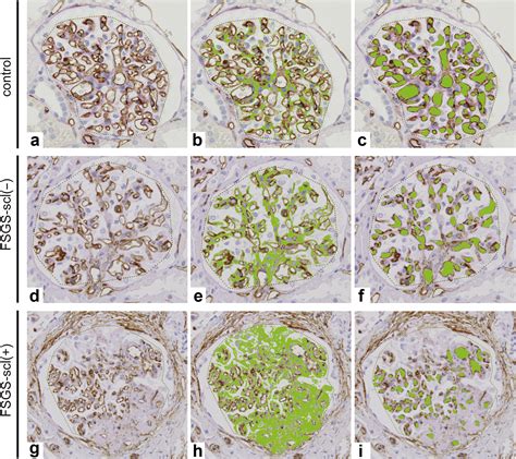 Diverse Alterations of Glomerular Capillary Networks in Focal Segmental Glomerular Sclerosis ...