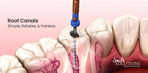 Is Root Canal Painless