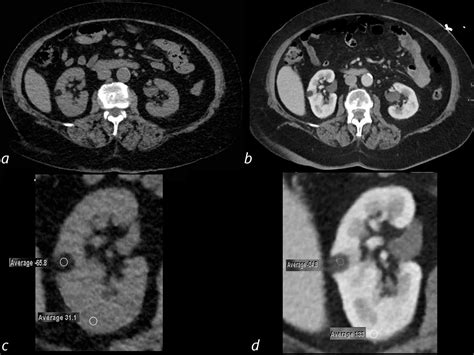Angiomyolipoma Of The Kidney