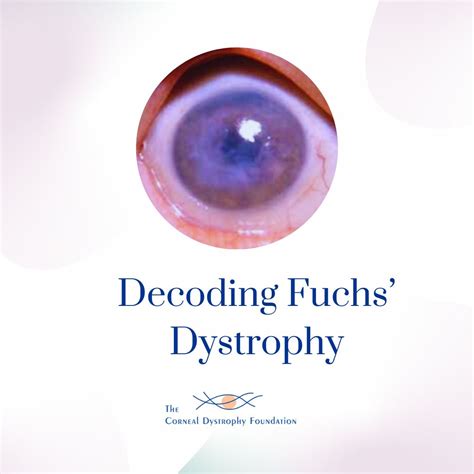 The Corneal Dystrophy Foundation on LinkedIn: #fuchs #dystrophy #knowledge