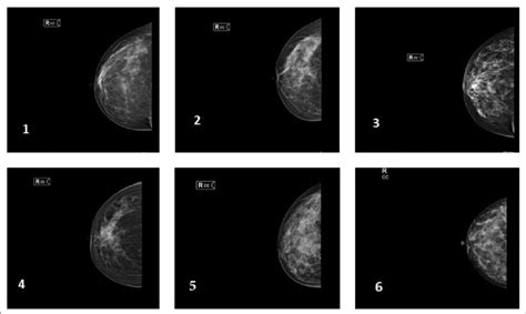 Image result for BI-RADS 0