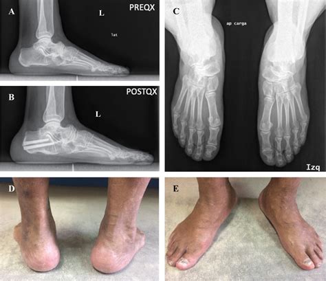 Lateral osteotomy of the calcaneus in the treatment of Müller-Weiss disease