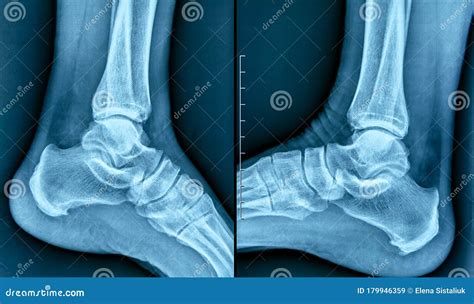 Heel Spur X Ray