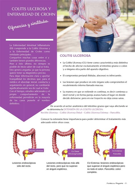 Enfermedad De Crohn Y Colitis Ulcerosa: Síntomas Y Diferencias – SXEO