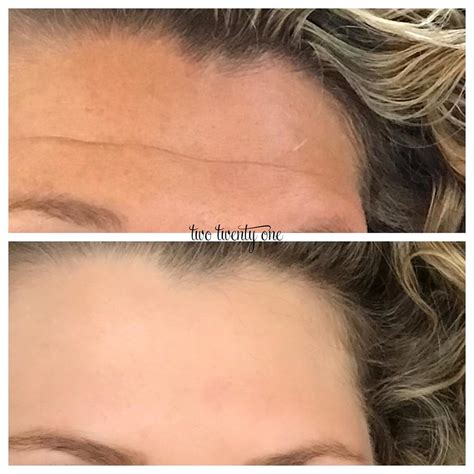 Botox Before and After - My Botox Experience