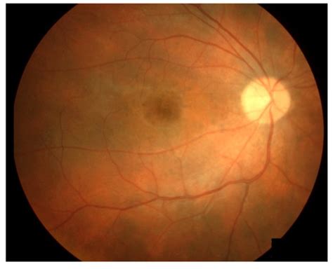 Diagnostics | Special Issue : Uveitis: Diagnosis and Management