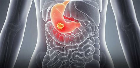 Carcinoid Tumour: Symptoms, Causes, Diagnosis, Treatment & Prevention